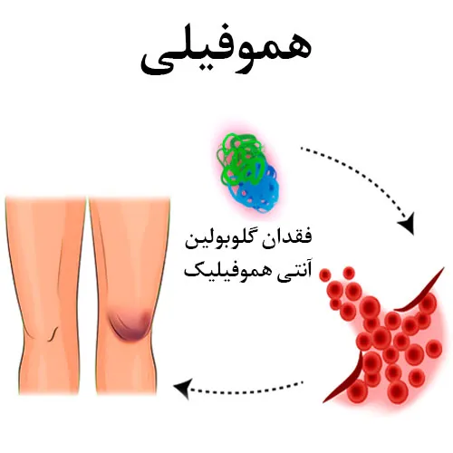 کنترل بیماری هموفیلی با داروی سیکلوکاپرون